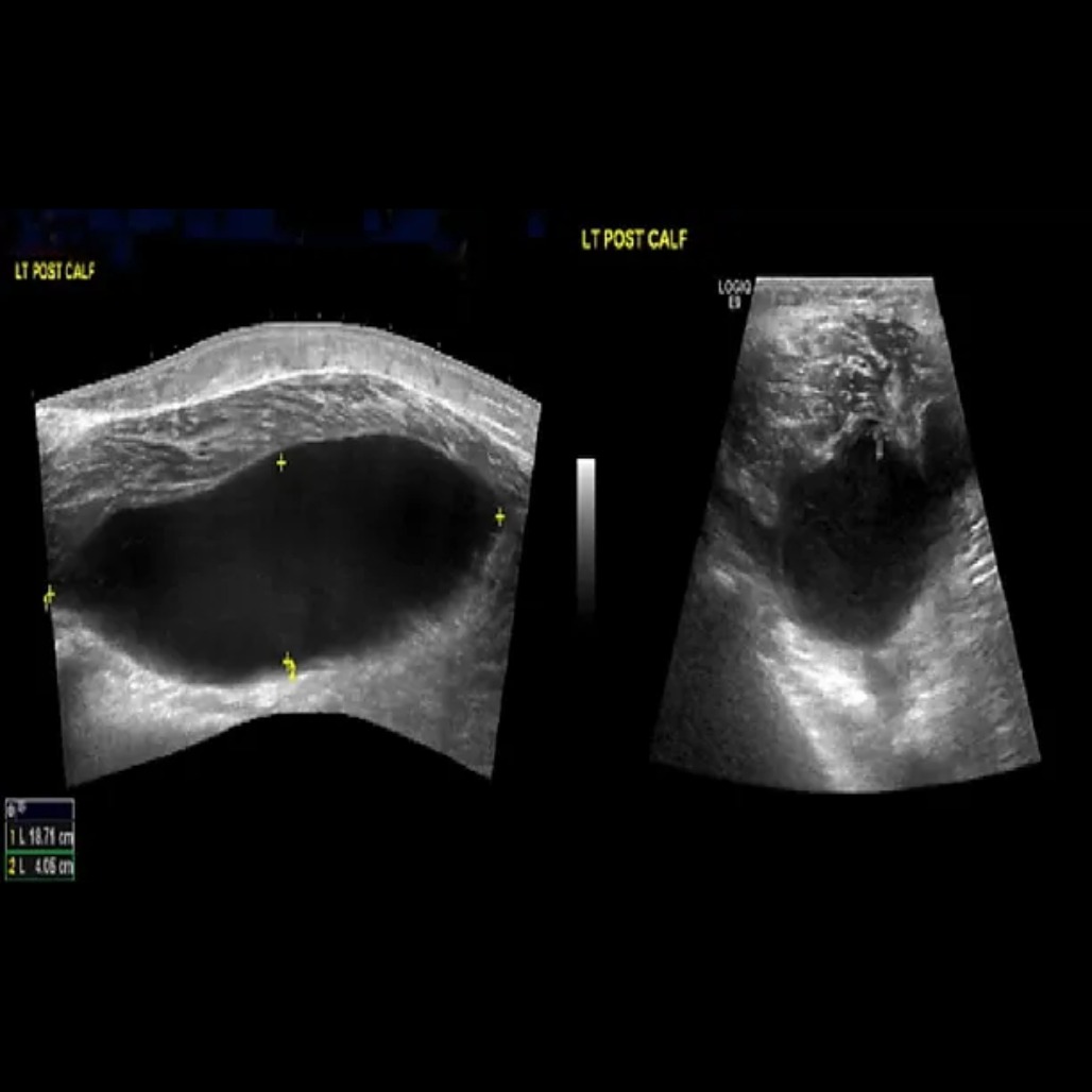 אולטרסאונד רקמות רכות