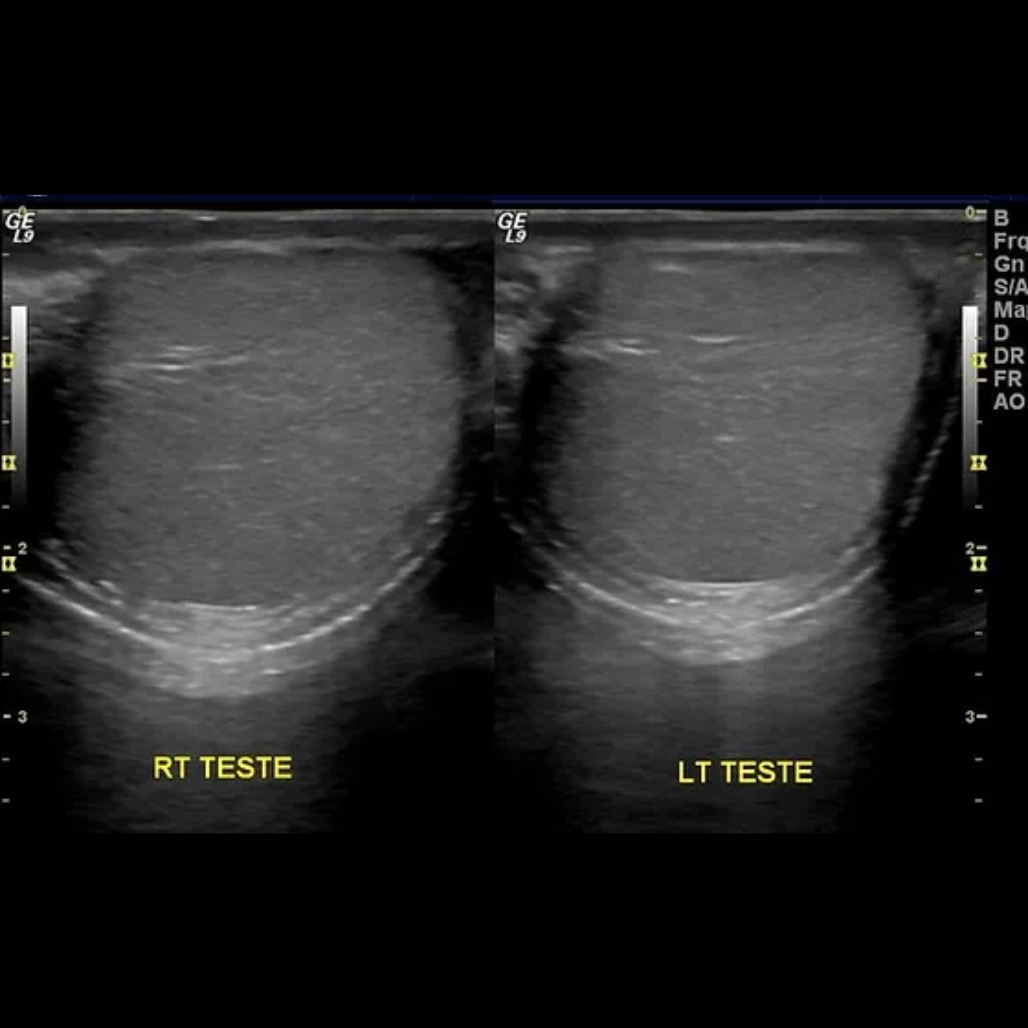 אולטרסאונד אשכים